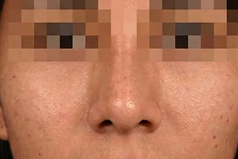 Después de Rinoplastia, paciente del Dr. Edgar Achá Vargas
