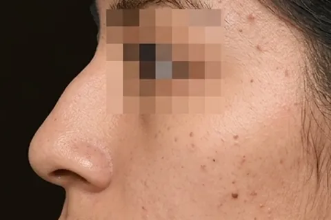 Antes de Rinoplastia, paciente del Dr. Edgar Achá Vargas