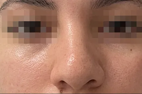 Antes de Rinoplastia, paciente del Dr. Edgar Achá Vargas